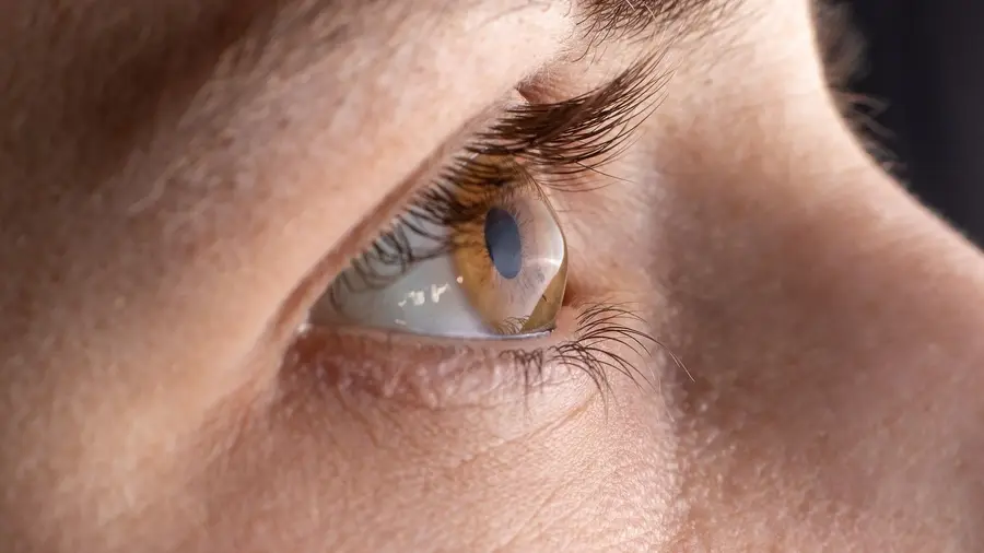 Studi Terbaru: AI Bantu Dokter Prediksi Kebutuhan Perawatan Pasien Keratoconus dengan Akurasi Tinggi